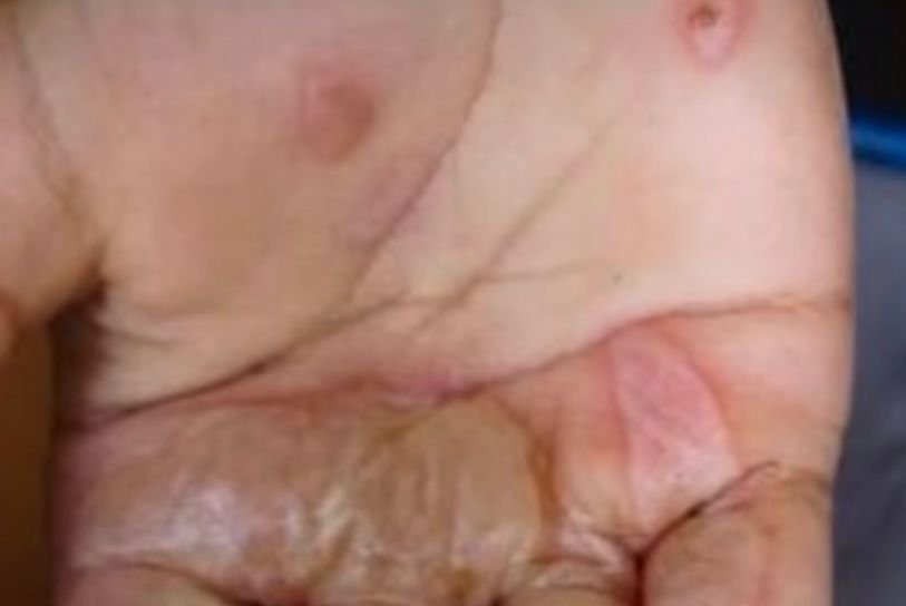 Mãe é presa por queimar mãos da própria filha como ‘punição’ em João Pessoa