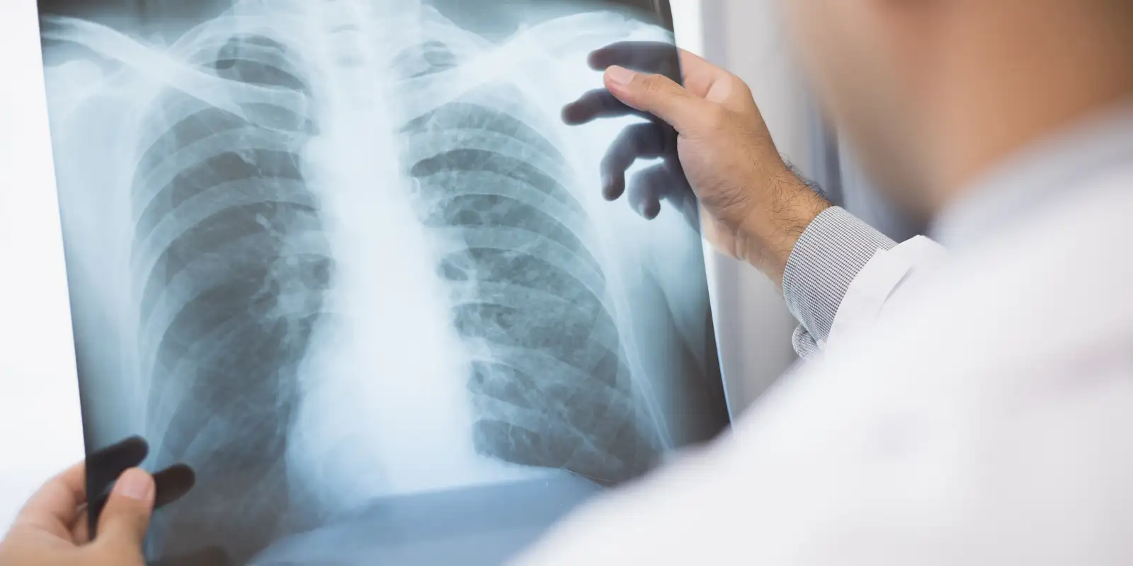Anvisa aprova novo medicamento para câncer de pulmão avançado Anvisa aprova novo medicamento para câncer de pulmão avançado