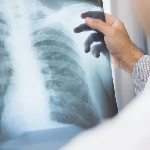 Anvisa aprova novo medicamento para câncer de pulmão avançado