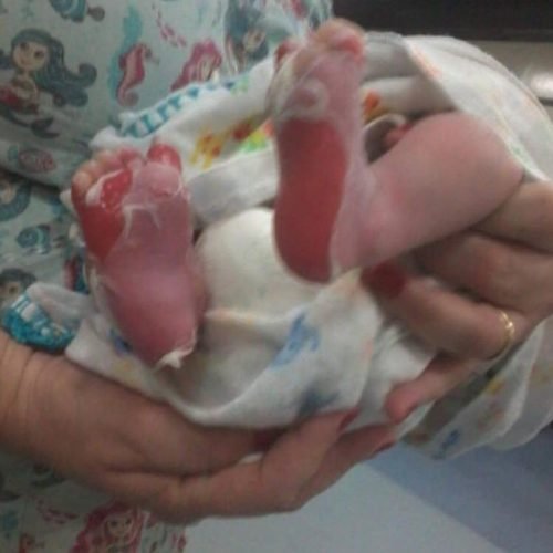 Em Itabaiana, bebê tem pernas e pés queimados após banho em hospital